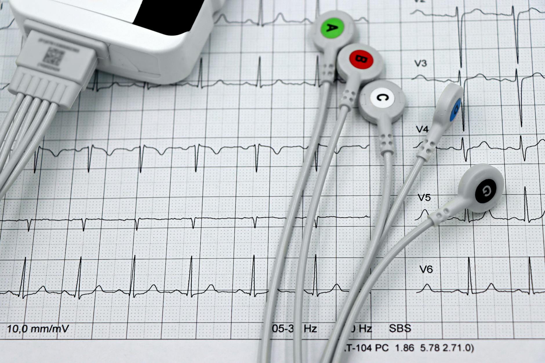 ECG monitor leads on a printed cardiogram tape — PDE5 inhibitor cardiovascular effects