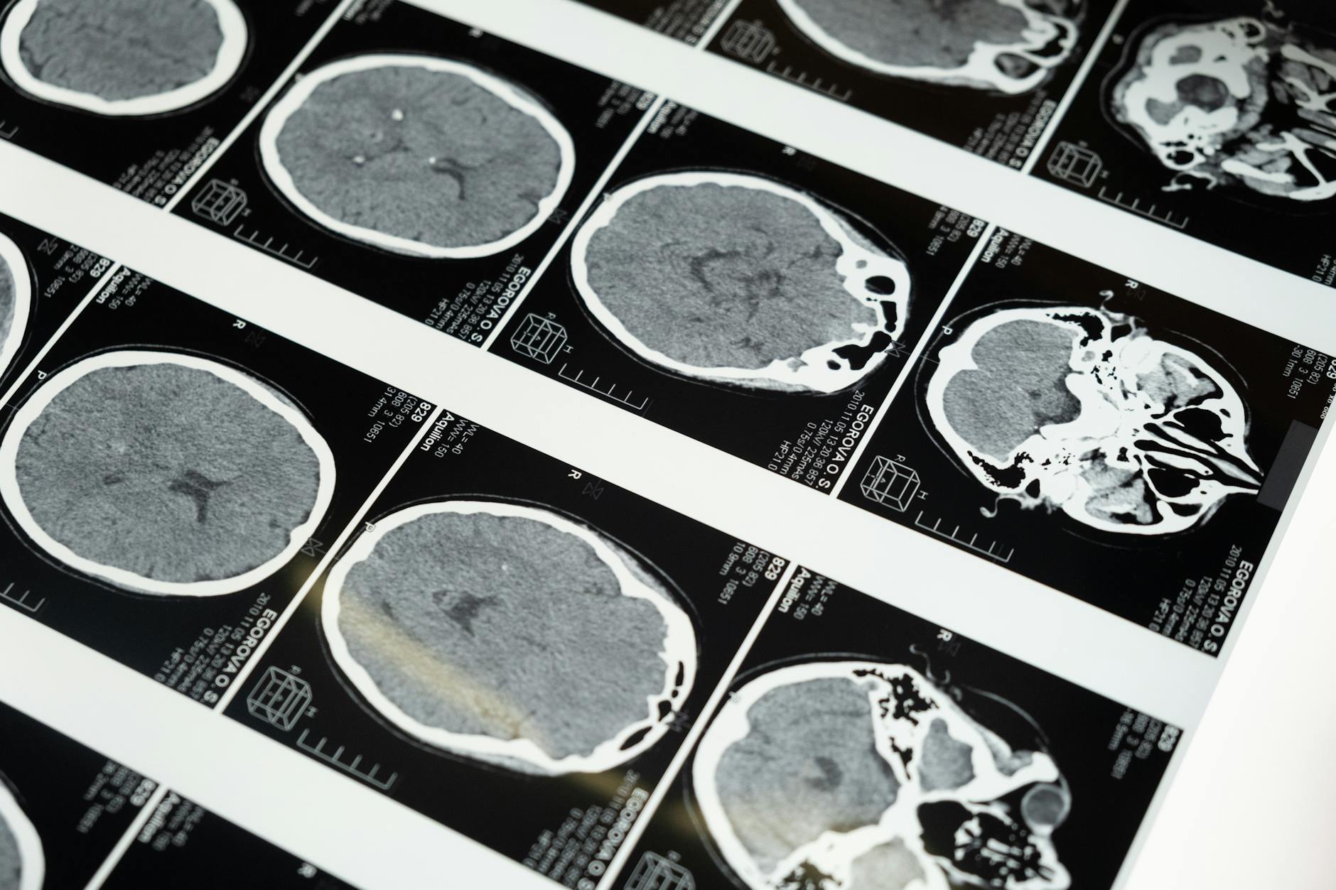 Overhead view of brain scan with neural connections