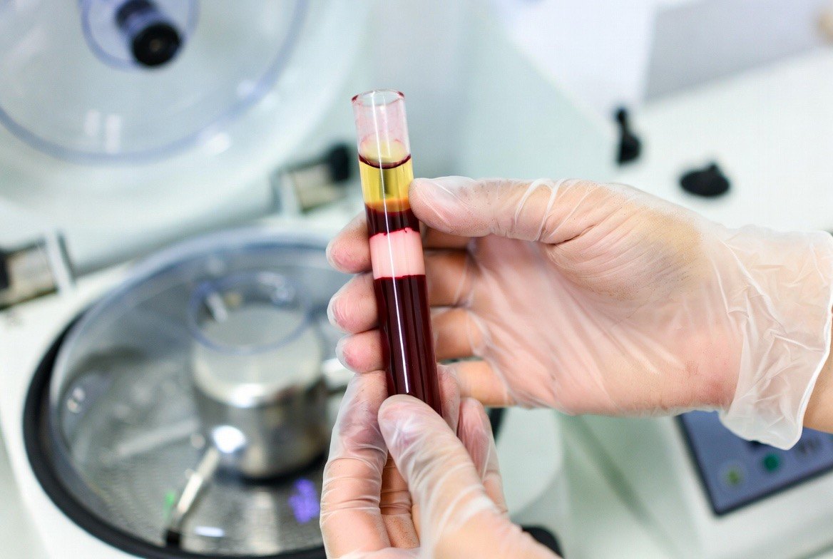 A gloved clinician holding a glass tube of centrifuged blood clearly separated into a lower dark-red red-cell layer and an upper straw-colored platelet-rich plasma layer, beside a benchtop centrifuge and a prepared syringe &mdash; the standard preparation step before a PRP injection