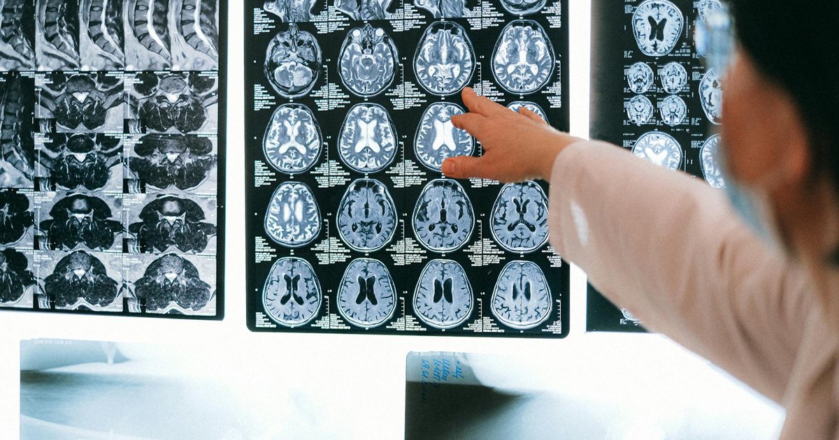 SMARCAD1 and Tauopathy: A Chromatin Lever on Alzheimer's