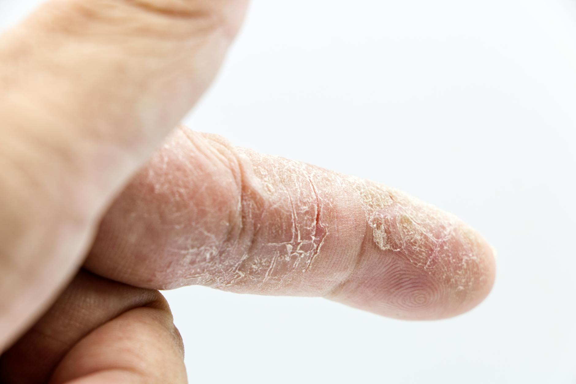 Skin inflammation dermatology treatment clinical — psoriasis research tirzepatide