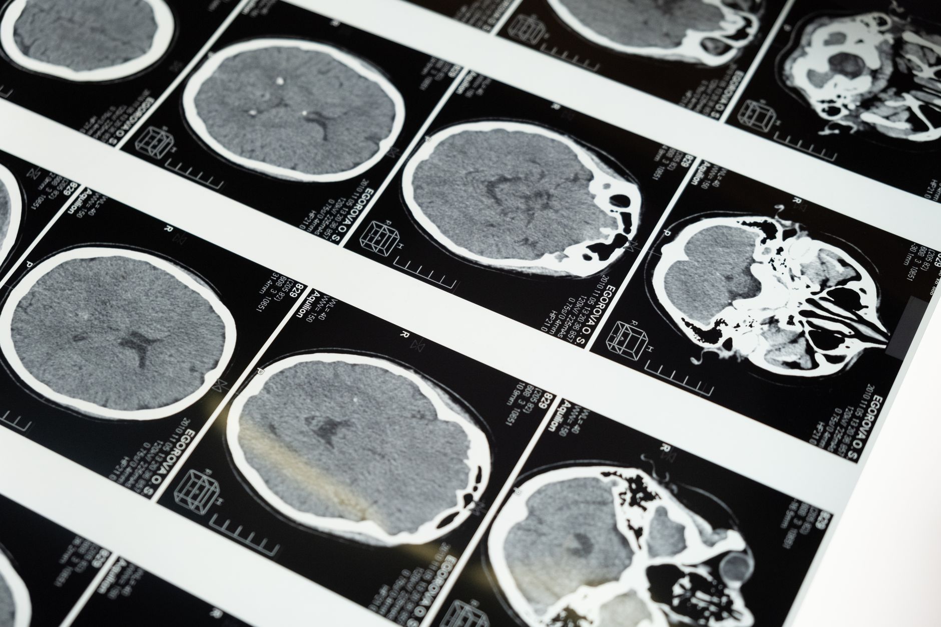 Grid of brain CT scans on a clinical lightbox — brain and cognitive health
